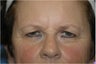 Pretrichial forehead lift and upper blepharoplasty