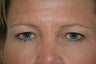 Forehead Lift