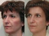 Endoscopic Forehead Lift