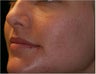 Fraxel - Acne Scarring