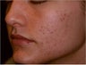 Fraxel - Acne Scarring