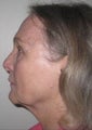Fractional Laser Resurfacing