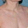 Fractional C02 laser for chest