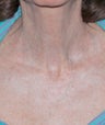 Fractional CO2 Laser Treatment