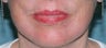 Fractional CO2 Laser Treatment