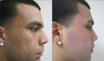 Fractional CO2 Resurfacing for Acne