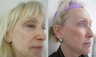 Fractional CO2 Laser Resurfacing