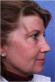 Laser Resurfacing