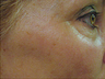 Fractional CO2 laser