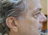 CO2 Fractional Laser