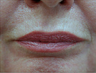 CO2 Fractional Laser Around Lips