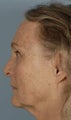 Fractional Laser Resurfacing