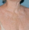 Fractional C02 laser for chest