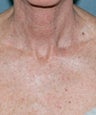 Fractional CO2 Laser Treatment