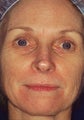 Fractional CO2 Laser Treatment