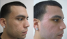 Fractional CO2 Resurfacing for Acne