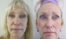 Fractional CO2 Laser Resurfacing