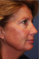 Laser Resurfacing