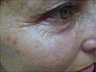 Fractional CO2 laser