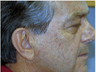 CO2 Fractional Laser