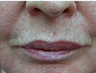 CO2 Fractional Laser Around Lips
