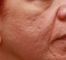Fraxel for Acne Scars