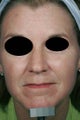 Fraxel