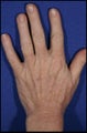 Fraxel