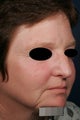 Fraxel