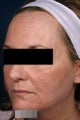 Fraxel - acne scars