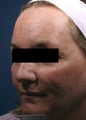 Fraxel - acne scars