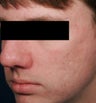 Fraxel -acne scars