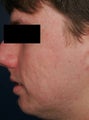 Fraxel - acne scars