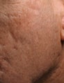Fraxel - acne scars