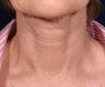 Fraxel Laser treatment
