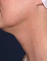 Fraxel - neck
