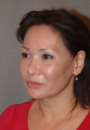 Fraxel Laser Rejuvenation