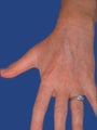 Hand Rejuvenation With Fraxel Dual Laser
