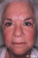 Fraxel Laser Treatment of Age Spots