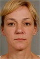 41 Year Old Female Treated for sun damage, wrinkles, and acne scars