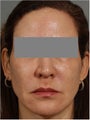 47 year old female treated for melasma, age spots, large pores and rough skin texture