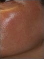 Fraxel - Melasma