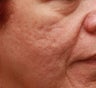 Fraxel for Acne Scars