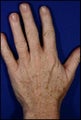 Fraxel