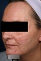 Fraxel - acne scars