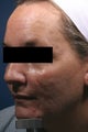 Fraxel - acne scars