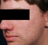 Fraxel -acne scars