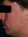 Fraxel - acne scars