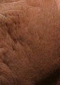 Fraxel - acne scars