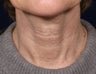 Fraxel Laser treatment